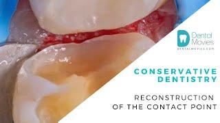 Conservative dentistry - reconstruction of the contact point