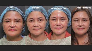 How to look 10 Years Younger in a Nonsurgical way | Dr. Contessa Salvador-Alapag