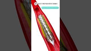 ANGIOPLASTY PROCEDURE #implant #medicalprocedure #biology #surgery #neet #medicalentranceexam #fyp