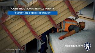 Animation Depicts Labor Worker's Femoral Fractures in Faulty Construction Site Fall Injury