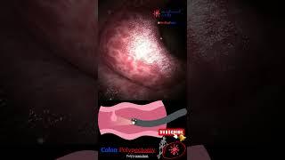 Coloscopy | Colon Polyp Resection | Polypectomy