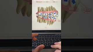 TIP 8 - OCCLUSAL CANT & ELASTICS