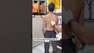 Severe spinal deformity scoliosis treatment by DrRavi #scoliosis #doctor #chiropractor #physio