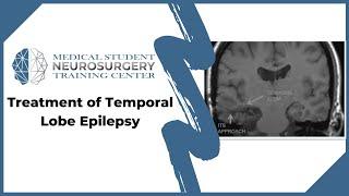 Treatment of Temporal Lobe Epilepsy