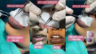 Vitiligo surgery SBG technique #shorts | SkinQure