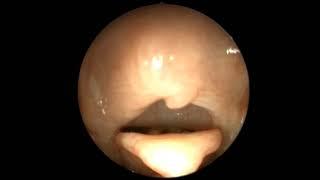 Hyperplasia of the suprarytenoid pharyngeal fold