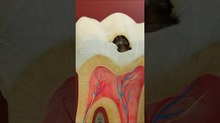 AMAZING Dental filling Procedure | Molar cavity filling with composite | CURVEIA  #shorts