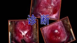 卫生部医学视听教材—妇产科—FC012 宫颈炎