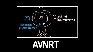 AV-Knoten Reentry Tachykardie (AVNRT) einfach erklärt