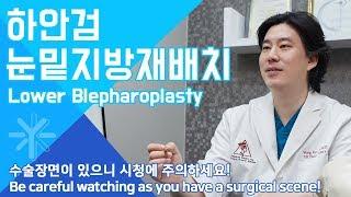 하안검눈밑지방재배치, lower blepharoplasty