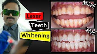 Teeth Whitening With Laser | Fastest & Safest way