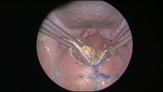 Zeta Palatoplasty - Done by Dr. Dipankar Datta