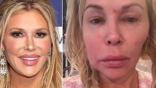 Brandi Glanville Opens Up About Health Struggles and Dr. Terry Dubrow's Support