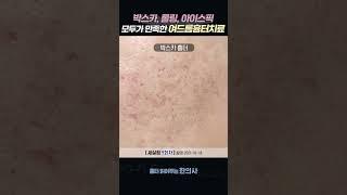  모~두가 만-족! #여드름흉터치료 #여드름흉터제거 #박스카흉터 #롤링흉터 #아이스픽흉터 #송곳형흉터