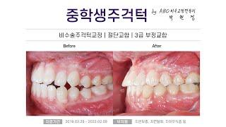 [치아교정] 중학생주걱턱교정(비수술주걱턱교정, 절단교합, 3급 부정교합) 교정전후 ; 뉴욕스마일치과의원