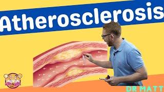 Atherosclerosis - Pathogenesis, risk factors and complications