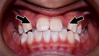 Kéo răng khi niềng răng | Braces pull teeth