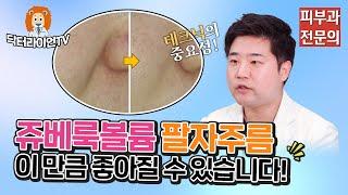 쥬베룩볼륨 팔자주름 효과 얼마나 좋아질까? "테크닉의 중요성"