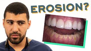 Flat Teeth? Tooth Surface Loss Summary | Erosion Abrasion Attrition Abfraction