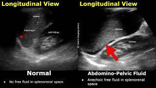 FAST Ultrasound Scan Normal Vs Abnormal Images | Focused Assessment With Sonography For Trauma USG