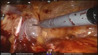 Robotic prostatectomy by Edward Schaeffer, MD, PhD