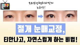 [모티브 성형외과] 절개 눈매교정도 티안나고 자연스럽게 하는 비법 공개! 모티브성형외과의 노하우!