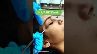 Milia removal /Dr. Sanchika Gupta ‍️