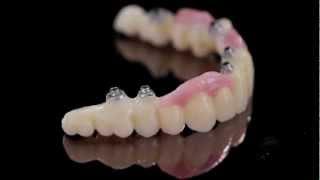 K Dental Lab-Zirkonzahn Prettau-Implant screw-retained bridge-1.mov