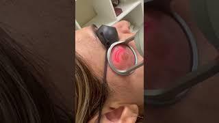 Fractional Co2 laser for pigmentation