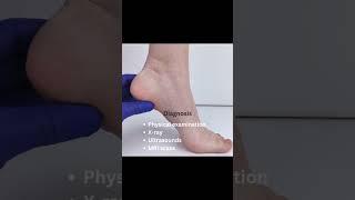 Heel Spurs Treatment #explore #chronicpain #heels #shorts #heelpsurs #shockwave