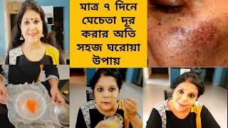 মাত্র ৭দিনে মেচেতা থেকে মুক্তি।।অতি সহজ ঘরোয়া উপায়ে দূর করো মেচেতার দাগ।।Get rid of Pigmentation।।
