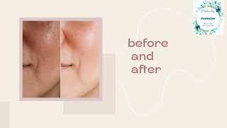 pigmentation treatment// fantaize beauty and health gallery//