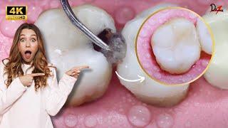 Satisfying Dental Restoration 4K #ASMR