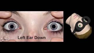 Left Posterior Canal BPV (Benign Positional Vertigo)