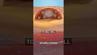 Should You Pop Your Blisters?   Surgeon Reacts
