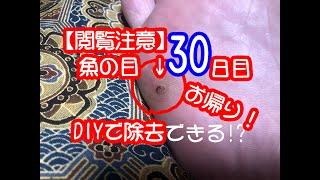 【閲覧注意】魚の目をDIYで除去する動画【30日目】