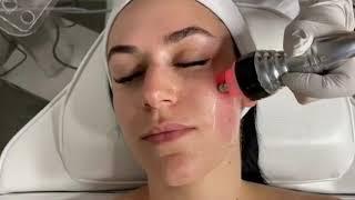 Restore Radiofrequency and Microcurrent For the Face/ 6-in-1 Cavitation System