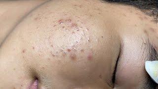 ACNE TREATMENT VU QUYNH MI | Perennial Blackheads On Teen Face 2024(FULL)