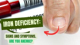 Iron deficiency: signs and symptoms. Are you anemic?