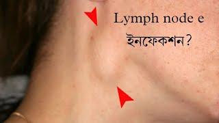 Lymph node e ইনফেকশন/Lymphadenitis/Dr.Joydeb Singha|Lymph node swelling