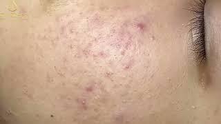 Loan Nguyen Acne Treatment 5b