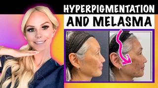 GLOWING SKIN - Hyperpigmentation vs Melasma - How to Treat Dark Spots and Sunspots