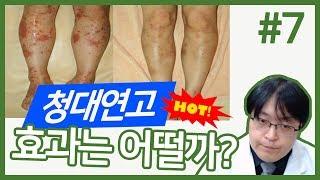 #7 건선에 많이 쓰이는 청대크림에 함유된 청대성분의 효과는?(후기/구매링크 설명참조)