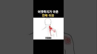 어깻죽지가 아픈 진짜 이유  #목디스크 #거북목 #일자목