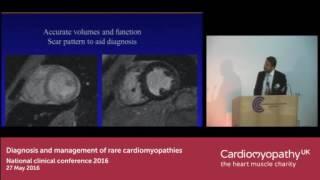 Rare causes of dilated cardiomyopathy and how to spot them