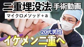 【閲覧注意】20代男性二重埋没法手術のリアル映像 #聖心美容クリニック #美容 #整形 #美容皮膚科#二重整形#二重