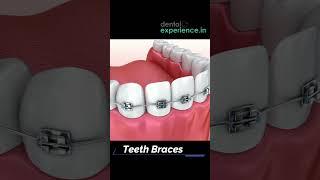 Metal | Ceramic Teeth Braces or Clear teeth aligners cost in Kerala, Kochi.