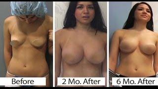 Breast augmentation - before and after video breast augmentation