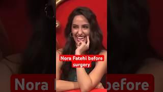 Nora Fatehi before surgery #nora #shorts #norafatehi #plasticsurgery