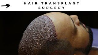 HAIR TRANSPLANT SURGERY AND AFTER -Now Hair Time